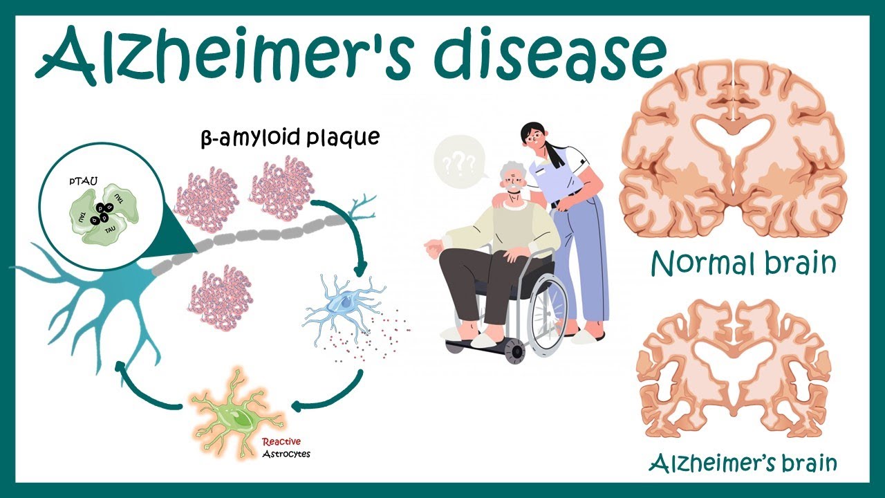 Alzheimer's Disease